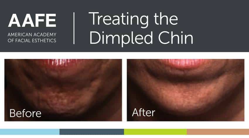 Dimpled Chin Before and After Pictures