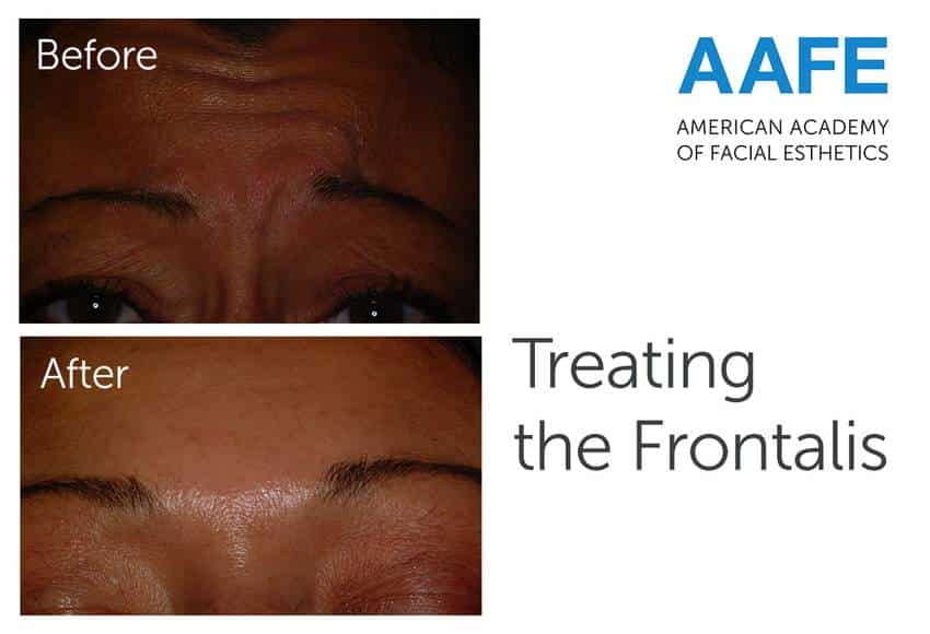 Frontalis Before and After Pictures